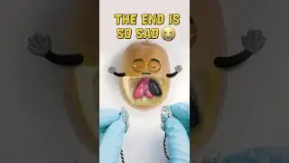 Mr. Kiwi Fruit Surgery goes Deadly wrong😭💔 - Lung Transplant 