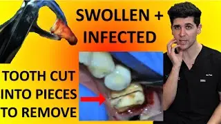 SECTIONAL EXTRACTION OF LOWER MOLAR (Tooth #46 or #30 Removal) Commentary and Walkthrough