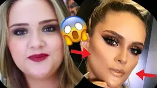 Diário da BICHECTOMIA|Dói muito? Pós operatório, preço|RESULTADO FINAL