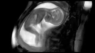 Images émouvantes d’une échographie montrant un bébé qui se déplace dans le ventre de sa mère!