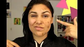 ELIMINA MANCHAS DE LA PIEL Y ACNÉ PARA SIEMPRE ? / 4 tips