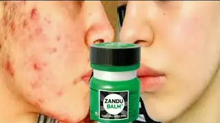 How to cure your pimples !!  Zandu balm to cure pimple problem / DOES IT WORK ??