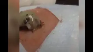 Blackhead and Oozy Pimple popping Compilation