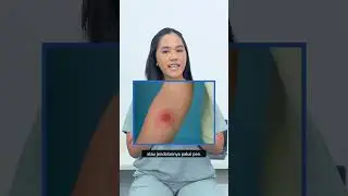 Share Info Ini Habis Tes Mantoux