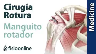 Lesión del manguito rotador - Qué es, diagnóstico y tratamiento indicado en fisioterapia y cirugía