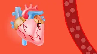 Heart  attack Animated Surgical video for medical interns