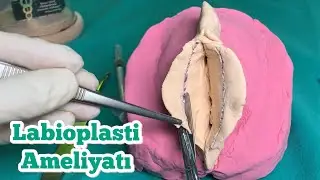 ✂️ Labioplasti Ameliyatı Nedir? | İç Dudak Estetiği Şekli Nasıl Olmalı? | Labiaplasty Antalya Turkey