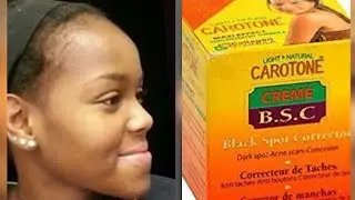 HOW TO REMOVE DARK SPOTS FROM FACE FAST (ACNE SCARS)