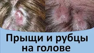 Прыщи и рубцы на голове