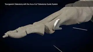 Youngswick Animation with Accu-Cut Osteotomy Guide