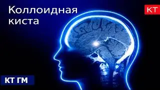 Коллоидная киста 3 желудочка на КТ