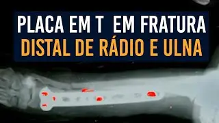 Caso clínico fratura de rádio e ulna distal