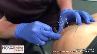 Dry Needling On A Weightlifter's Shoulder