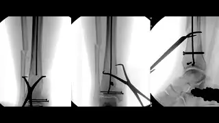 Extreme nailing of intraarticular fractures in the lower extremity
