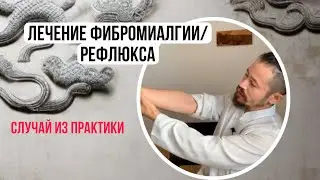 Лечение фибромиалгии/рефлюкса с помощью акупунктуры. Случай из практики (фрагмент эфира)
