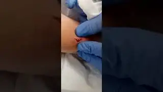 Caiden gets pimple lanced