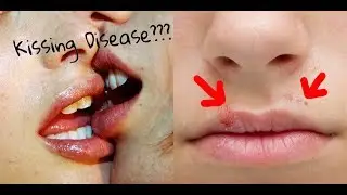 DISEASES YOU CAN GET THROUGH KISSING. सावधान ! Kiss करने से भी होती हैं ये बीमारियां