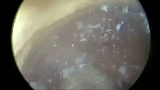 Miomectomía Histeroscopica