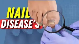 Nail Diseases: What Your Nails Tell You About Your Health
