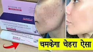 Elosone HT cream | Uses, benefits, side effects | Hindi review