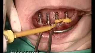 SKY fast & fixed in the endentulous mandible implantation - immediate fixed bridge