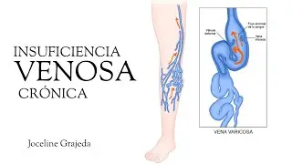 Insuficiencia venosa crónica