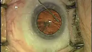 High Efficiency Cataract Surgery by Dr. Shawn Cohen; Narrated