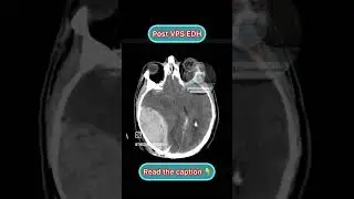 CT Brain📌📌📌:●EDH a very rare complication for VP shunt placement, @thesurgerytimes