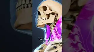Neck Strains and Sprains