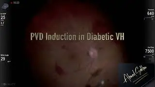 PVD induction in diabetic vitreous hemorrhage