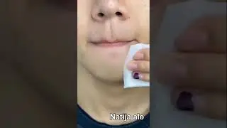 yuzdagi doglarni ketgazadi ba qora nuqtalarni