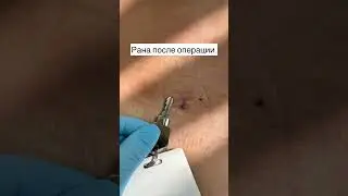 Вылечили грыжу диска за 2 часа