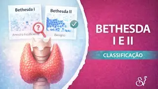 Bethesda I e II da punção de nódulos de tireoide