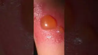 What Are the 3 Main Types of Burn Injuries?