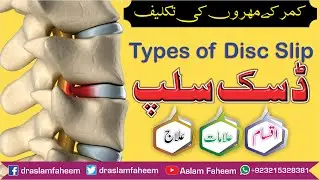 4 Types of Disc Slip | Explanation of Disc Bulge & Slip Disc | Disc Problem Treatment in Homeopathy