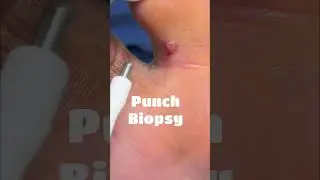 Get Suspicious Lesions Checked!