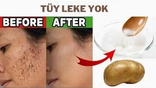 Patates Nişastası Yaparsanız, Yüz Lekesi Hiç Kalmaz. Ev Yapımı Etkili Cilt Beyazlatıcı!