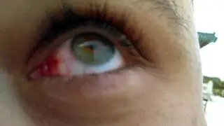 Man cries blood