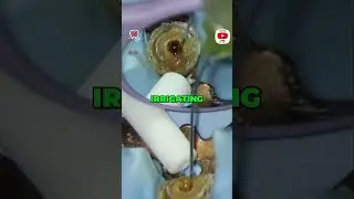 Mastering Irrigation Techniques  Reroute Treatment Essentials