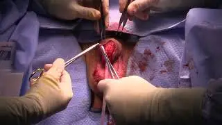 Core Videos (2024): Penile Cancer – Partial Penectomy