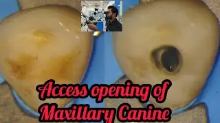 Access opening of Maxillary Canine step by step demonstration# rct for beginners #rct#dentallectures