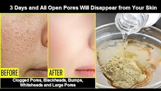 3 Days And All Open Pores Will Disappear From Your Skin|Shrink Open Pores, Blackheads & Large Pores