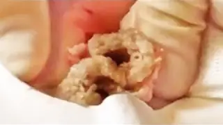 Mother of All Cysts!  Cyst Removal, Popping & Dallas Dermatology