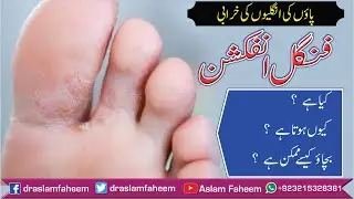 How to Get Rid of Fungal Infection of Feet Athlete's Foot Hindi/Urdu | Fungal Infection Home Remedy