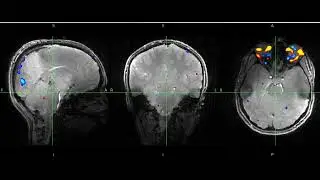Blinking cannot be considered a mere simplification; it involves neuronal mechanisms. #PETALUTE #UHF