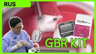 [Практические советы] GBR KIT - Операция в зоне зуба #11