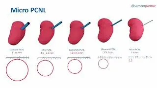 Percutaneous Nephrolithotomy (PCNL)