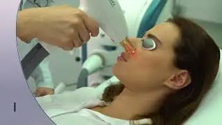 Фракционное неабляционное омоложение на аппарате М22 при помощи уникальной насадки ResurFX