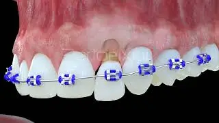 Vídeo 3D Extrusión ortodóntica forzada - Tráiler