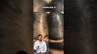 Queda de Cabelo Nunca Mais: Meu Segredo Revelado! #QuedaDeCabelo #CabelosFortes #TratamentoCapilar